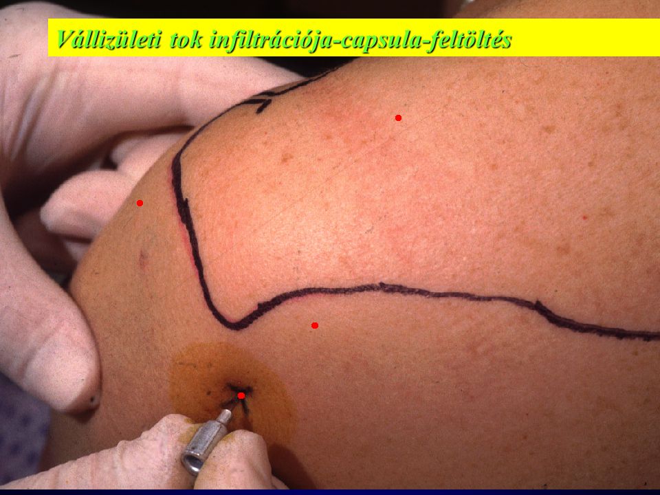 clavicularis acromialis ízületi ízületi kezelés)